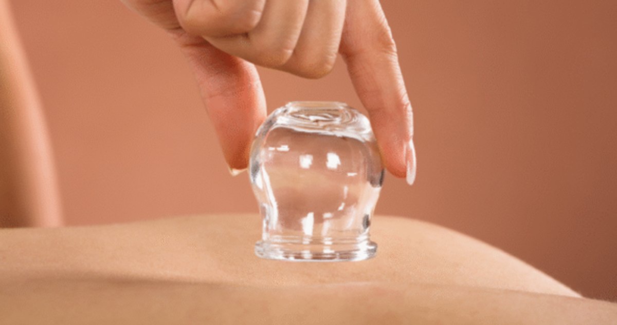 The Benefits of Cupping Therapy: A Holistic Approach to Wellness
