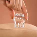 The Benefits of Cupping Therapy: A Holistic Approach to Wellness