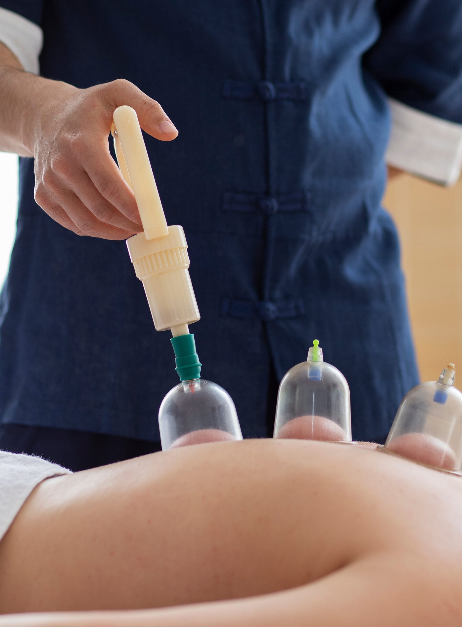 Wet Cupping (Hijama)