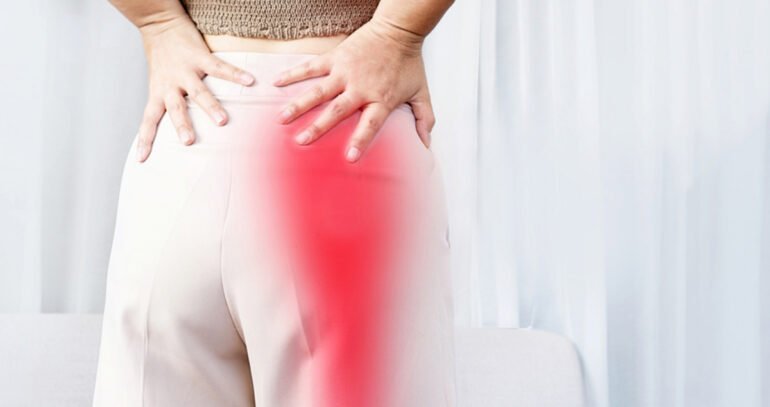 Cupping therapy for sciatica treatment showing cups placed on the lower back and glutes