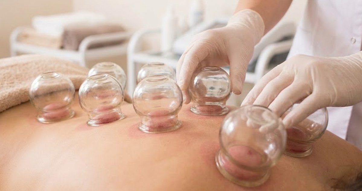 Benefits of Cupping Therapy for Chronic Pain